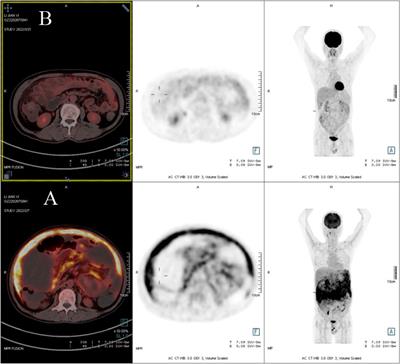 The successful treatment of Enterocytozoon bieneusi Microsporidiosis with nitazoxanide in a patient with B-ALL: A Case Report